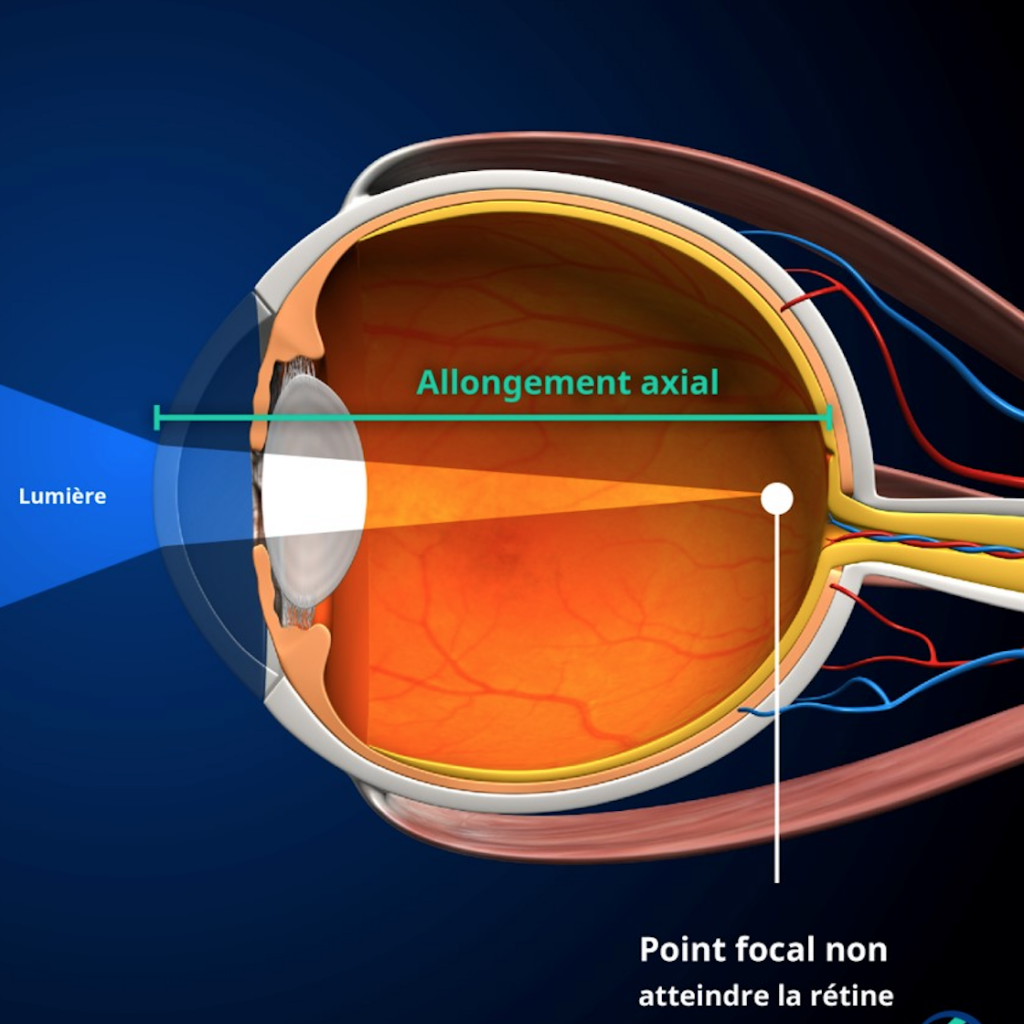 Étape 2 : À mesure que la myopie progresse, l'allongement axial et le désalignement du point focal augmentent et conduisent à une myopie forte.